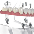 Алгоритм проведения операции имплантации зубов