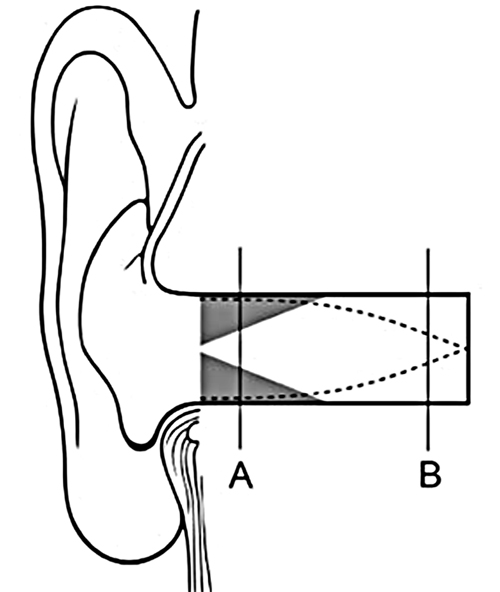 Закупорка наружной части слухового прохода
