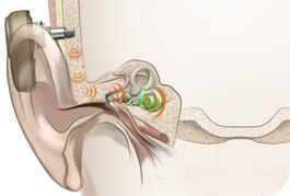 Принцип работы слухового аппарата костной проводимости
